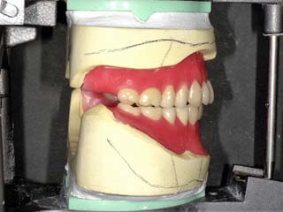 右側人工歯配列