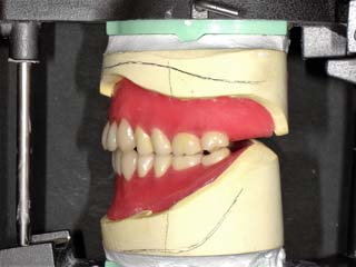 左側人工歯配列