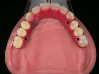 上顎人工歯配列