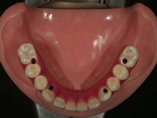 下顎人工歯配列