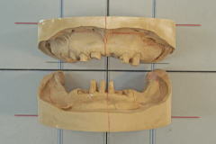 オーバーデンチャーの臨床技工 仮義歯の製作
