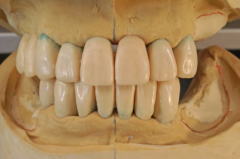オーバーデンチャーの臨床技工 臼歯人工歯仮排列