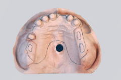 オーバーデンチャーの臨床技工 下顎フレームの外形線の印記