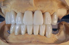 オーバーデンチャーの臨床技工 前歯切縁の位置は試摘時にドクターによって決定された。