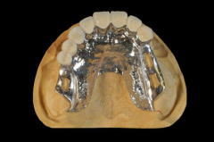 オーバーデンチャーの臨床技工 人工歯はジーシーリブデントグレースを使用しました。