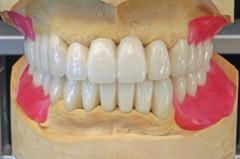 オーバーデンチャーの臨床技工 左上小臼歯は２８Ｍ 左下小臼歯は３３Ｍを使用。大臼歯は上下３１Ｍ