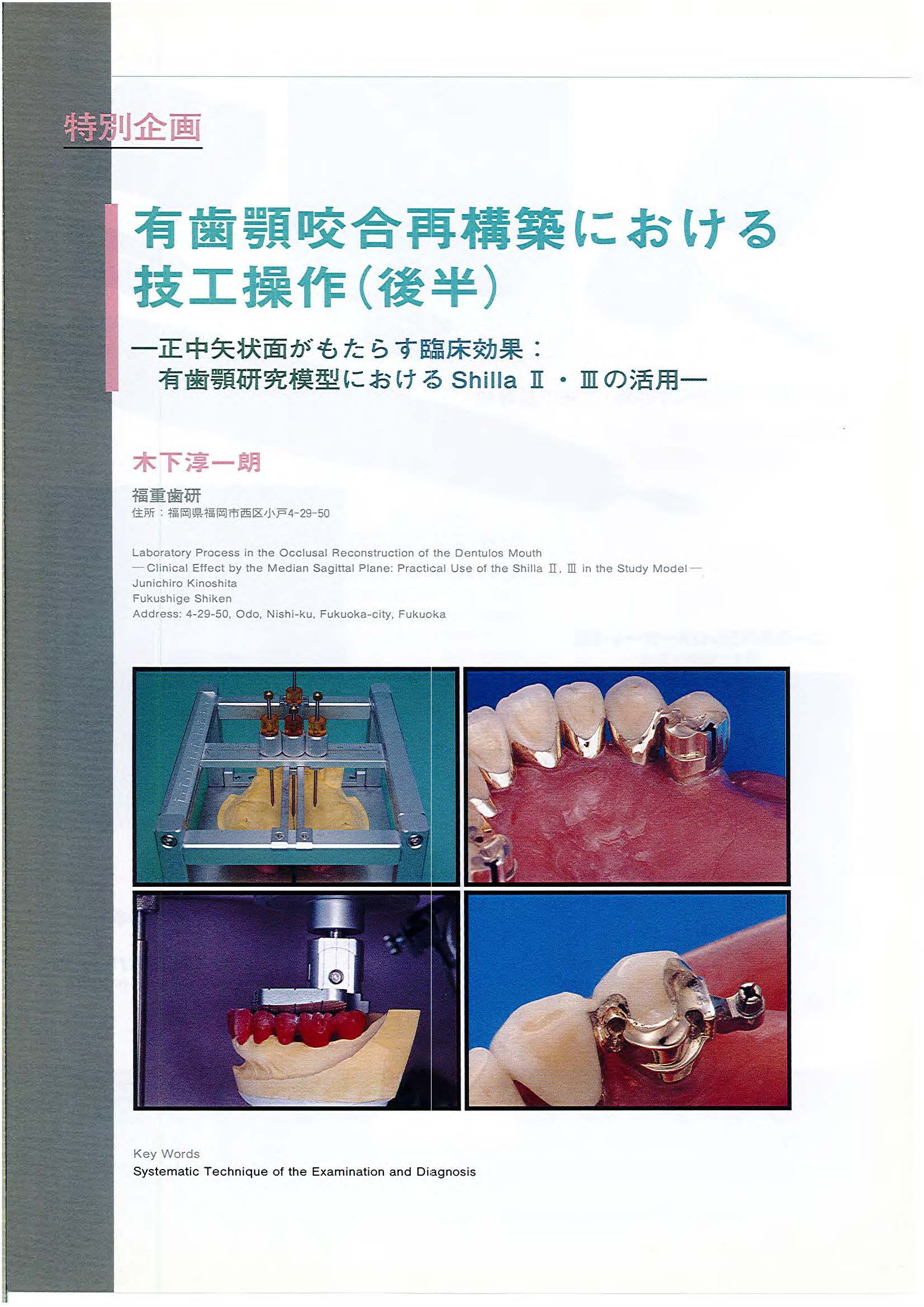 1998年論文・有歯顎咬合再構築における技工操作（後半）